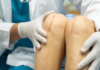 Knee replacement